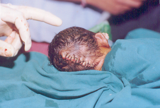 Meningocele Occipital Remov Ed